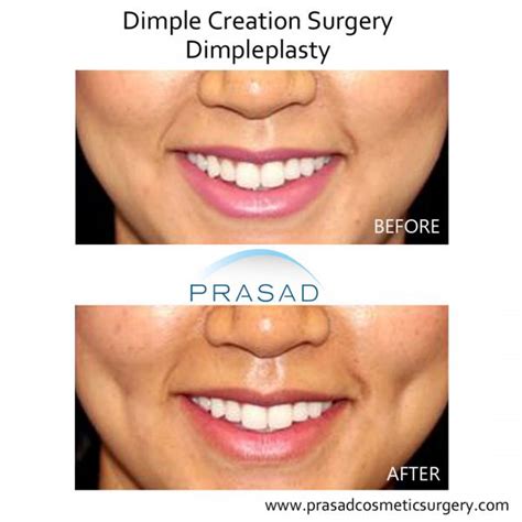 lv plastic surgery sinsa|plastic surgery for dimples.